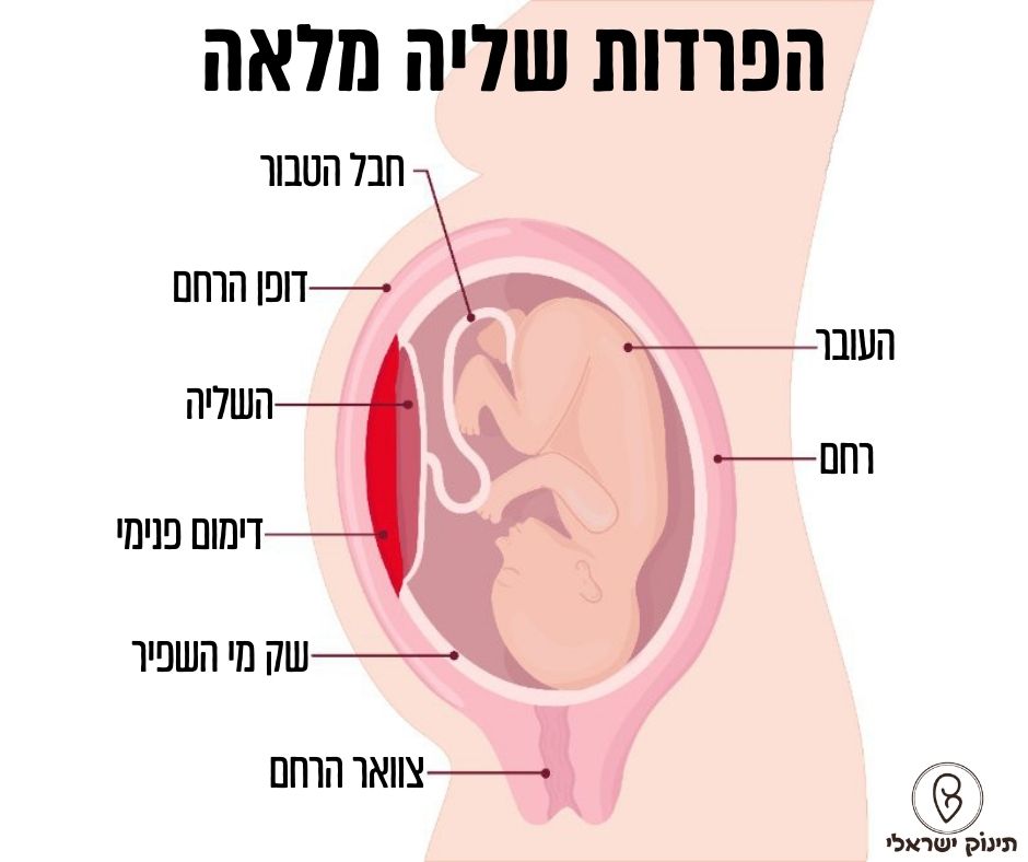 הפרדות שליה מלאה הפרדות שליה מלאה