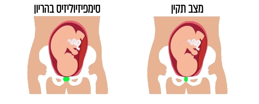 סימפיזיוליזיס בהריון סימפיזיוליזיס בהריון