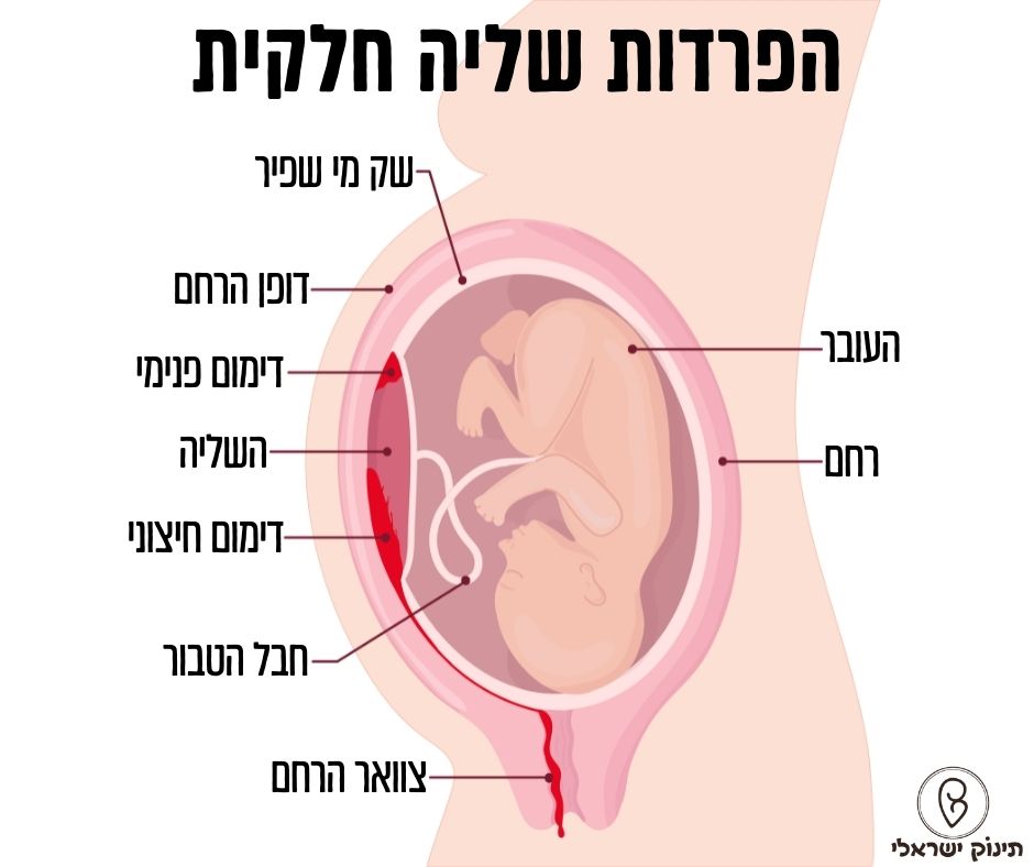הפרדות שליה חלקית הפרדות שליה חלקית